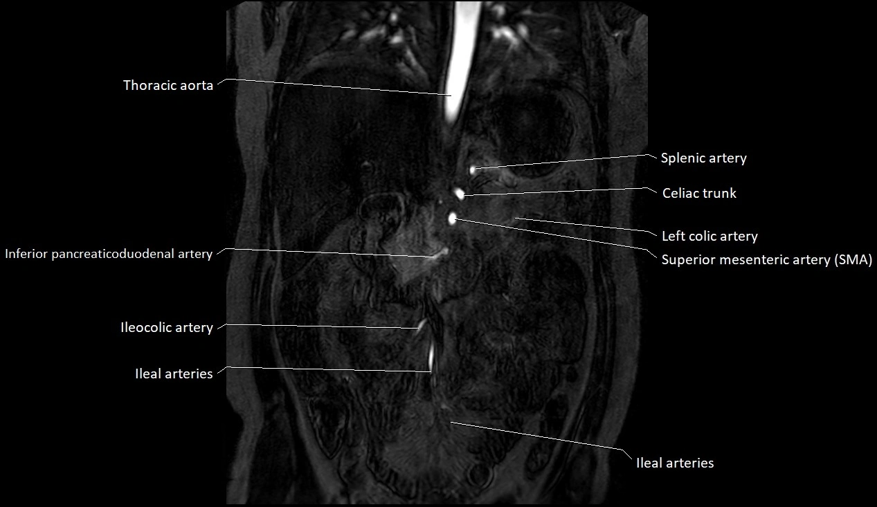MRA Abdomen coronal anatomy image 13.webp